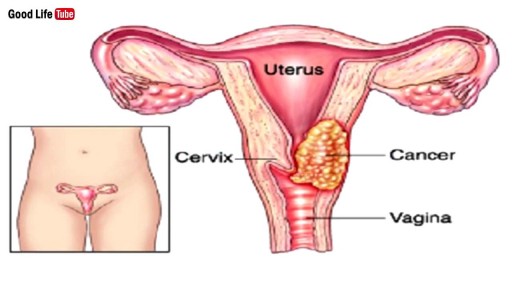 ⁣Signs of Genital Cervical Cancer You Should Know