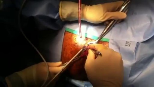 ⁣Hemorrhoids Surgical Repairing Operation