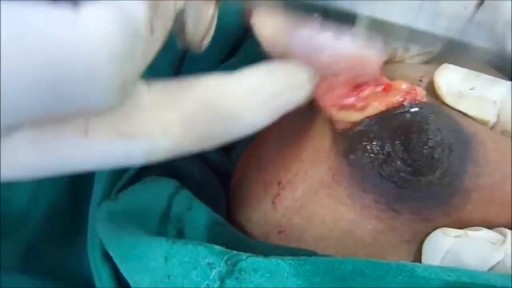 ⁣Massive Size Fibrodenoma Removal Under Local Anesthesia