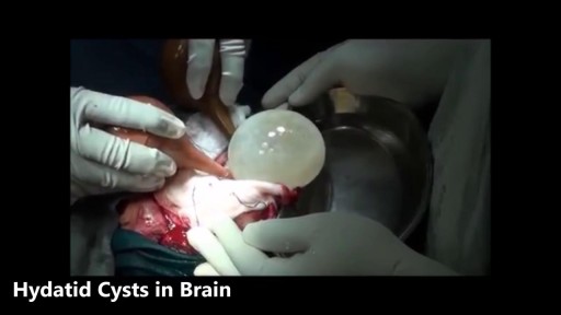 ⁣Worst Brain & Liver Cysts Removal