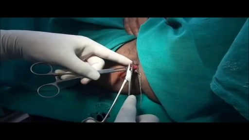 ⁣Hemorrhoids Repairing Medical Surgery Video