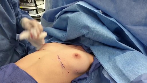 ⁣Breast Augmentation Short Scar Technique Slicone Implants