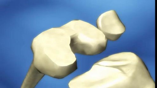 ⁣Total Knee Arthroplasty Animation