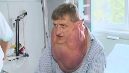 ⁣Massive Tumor Removed from Man's Face