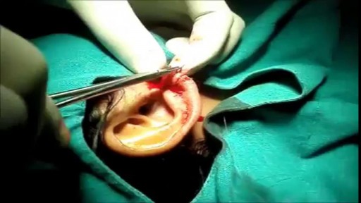 ⁣Ear Lobe Repair Surgery