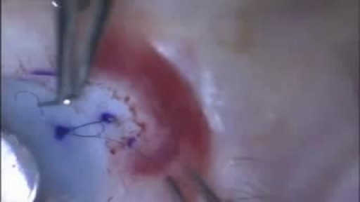 ⁣First corneal suture during cataract surgery