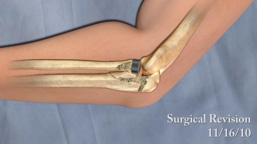 ⁣Surgical Animation of Elbow Injury