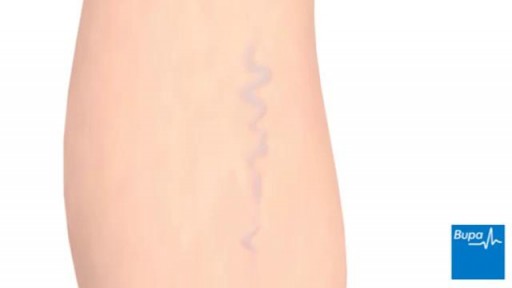 How varicose veins form