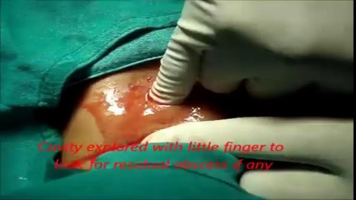 ⁣Popping a Large Abscess In A Young Female.
