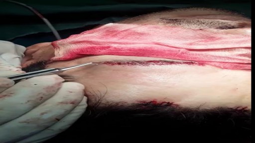 Eye Brow Transplant Procedure