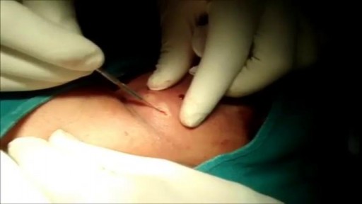 ⁣Surgery On Large Infected Sebaceous Cyst Neck