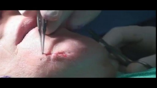 Mole Laser Removal
