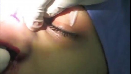 ⁣Nose Plastic Surgery: Open Rhinoplasty