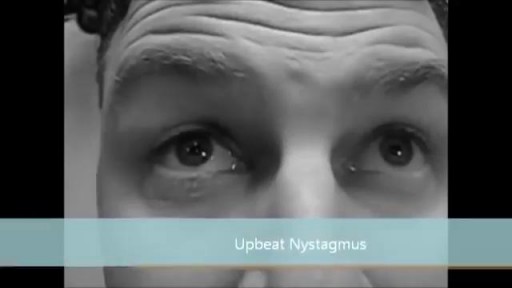 ⁣Types of nystagmus