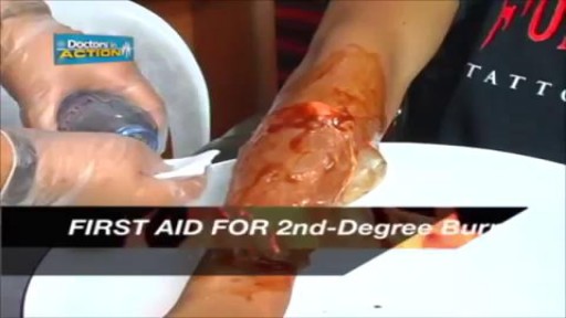 First Aid Treatment for Burn Injuries