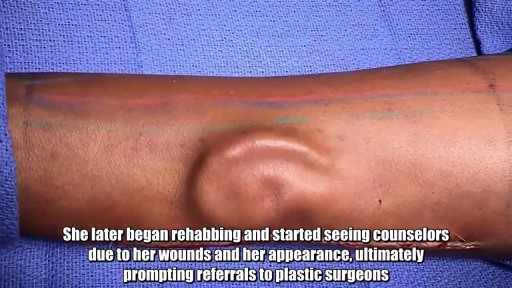 ⁣Doctors give soldier New Ear after growing it in her arm