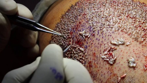 ⁣Hair Transplant Surgery with Grafts