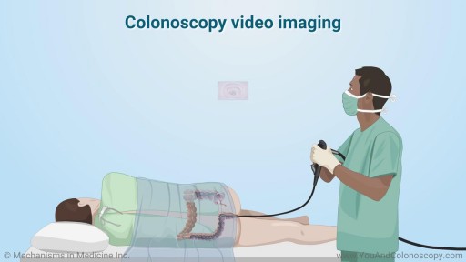 ⁣Colonoscopy: During and After