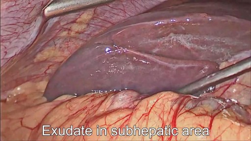 Laparoscopic Drainage of Large Liver Abscess