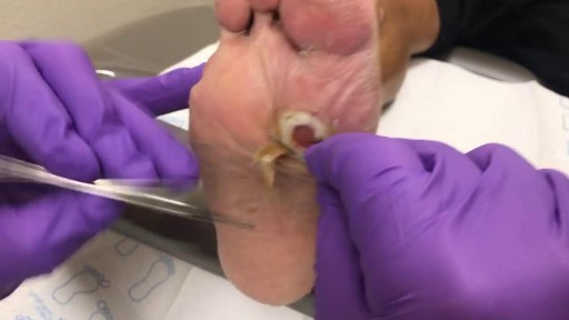 Debridement of Diabetic Foot Ulcer