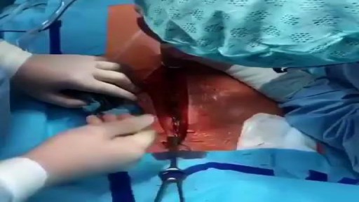 Median Sternotomy performed before open heart surgery !