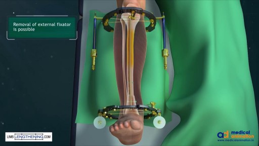 ⁣Tibial Bone Transport Over an Intramedullary Nail Using Cable and Pulleys