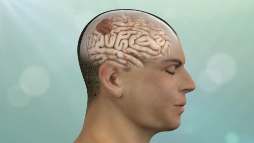⁣Keyhole Brain Tumor and Skull-Base Surgery