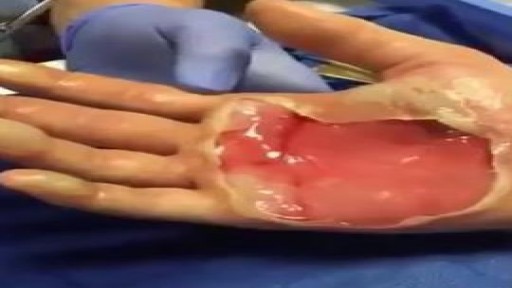 ⁣Popping a Second Degree Burn Blister
