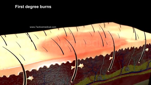 Burns Degrees Classification