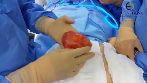 ⁣Breast  implant removed with capsule