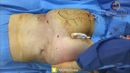 Brazilian Butt Lift (BBL) - Dr Eddy Dona demonstrates a typical BBL