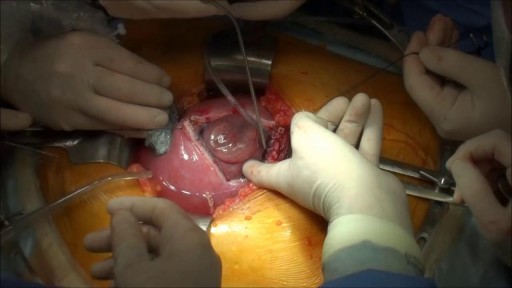 ⁣Surgery While Fetus is in Uterus to repair Spina Bifida