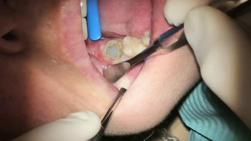 Badly Infected Wisdom Tooth