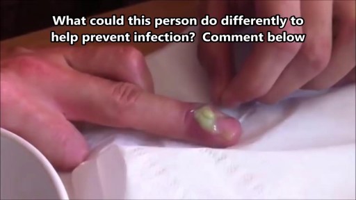 ⁣Popping Nail Abscess Infection