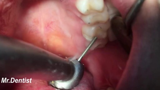 Tooth Cavity Filling