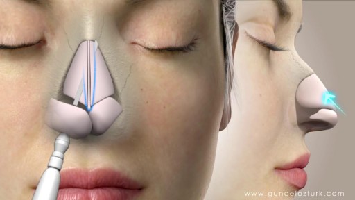 Nose Job Rhinoplasty Animation
