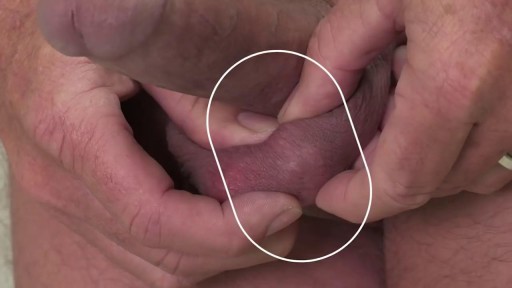 ⁣Penile Implant