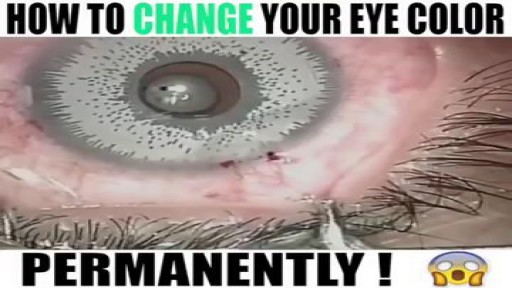 ⁣Eye Color Change Surgery with Implant