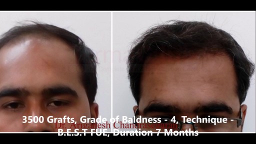 ⁣Hair Transplant Before After Photos @ DermaClinix Chennai | Dr. Ariganesh Chandrasegaran