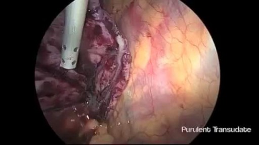 ⁣Thoracoscopic Management of Lung Abscess Before Empyema