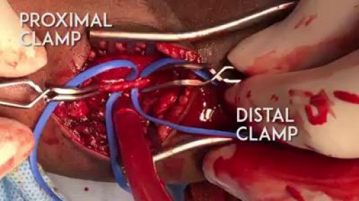 ⁣A proper embolectomy should have a good proximal and distal flow to the arteriotomy