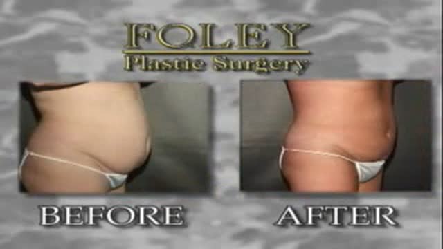 Liposuction for Weight Loss