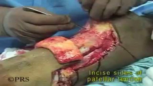 ⁣Knee Disarticulation