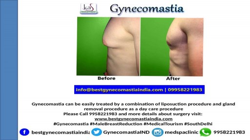 ⁣Specialist Gynecomastia Surgeon Clinic in South Delhi,India