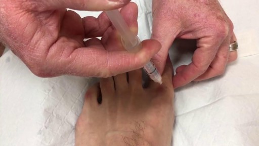 ⁣Local anesthesia in big toe for ingrown toenail removal