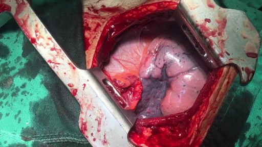 WOUNDED HEART SUrgery