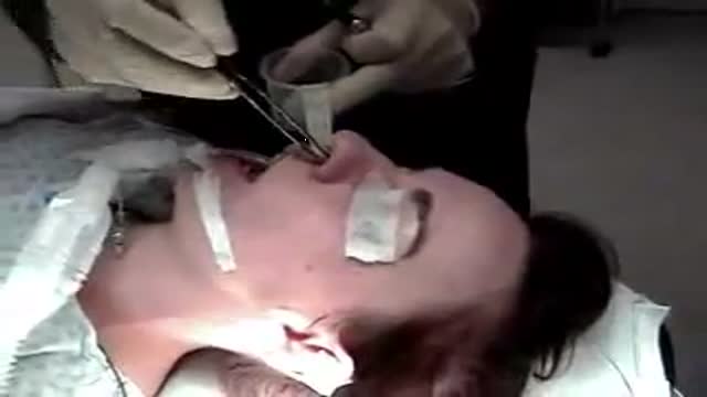 Open Rhinoplasty