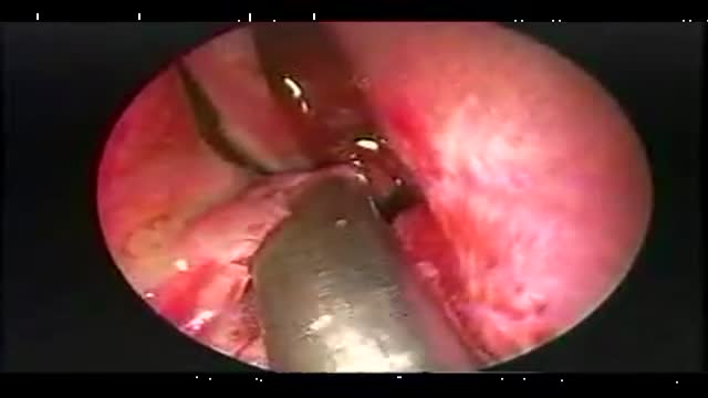 Nasal Septoplasty