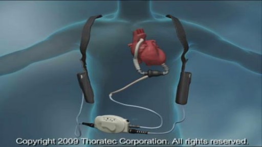 ⁣What is   Left Ventricular Assist Device ?