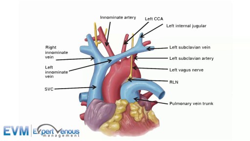 Superior Vena Cava (SVC) Syndrome